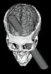 Phineas_Gage_CGI